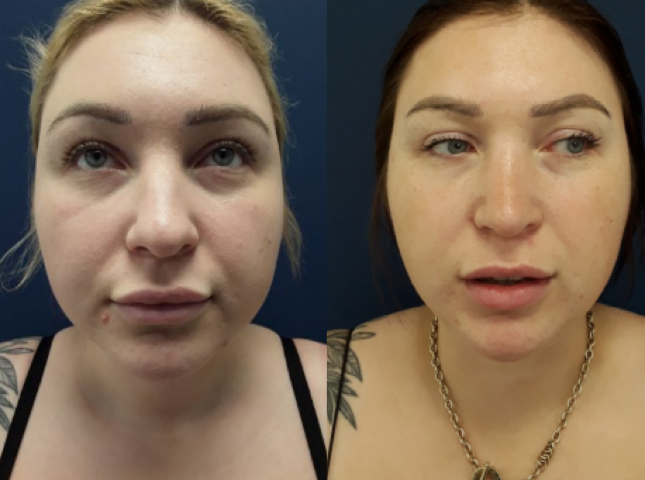 Before and after facial treatments