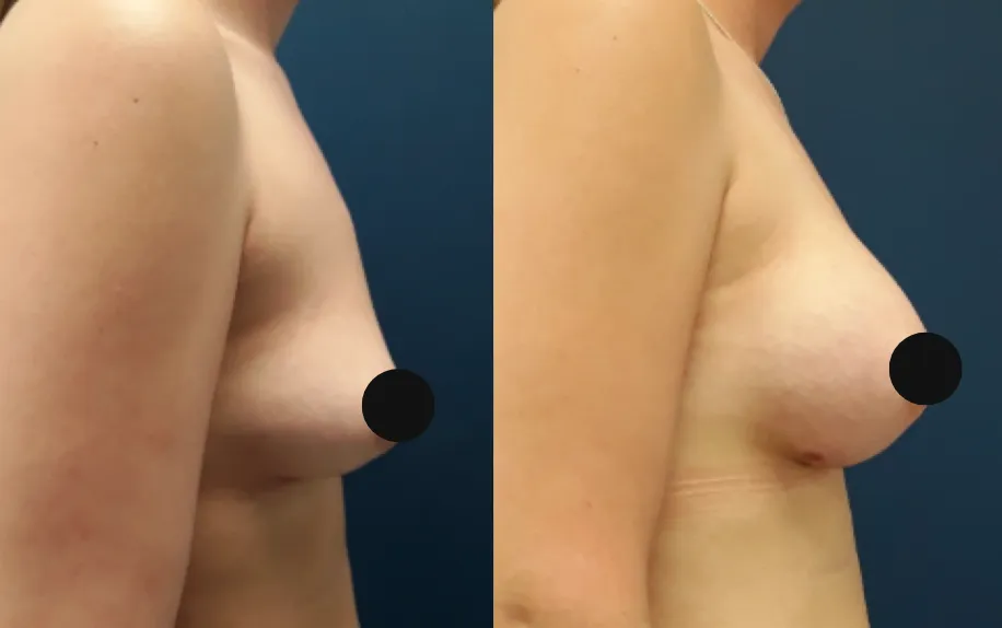 breast implant before and after at lux plastic surgery in bedfordbreast implant before and after at lux plastic surgery in bedford