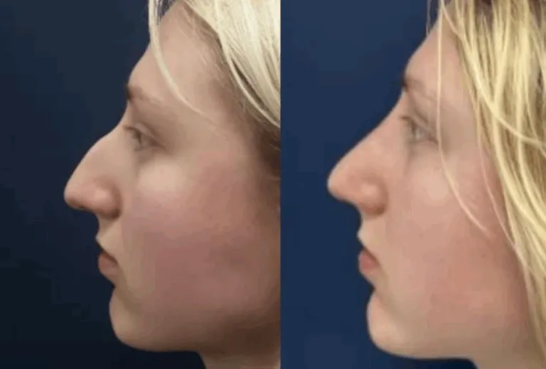 Rhinoplasty before and after