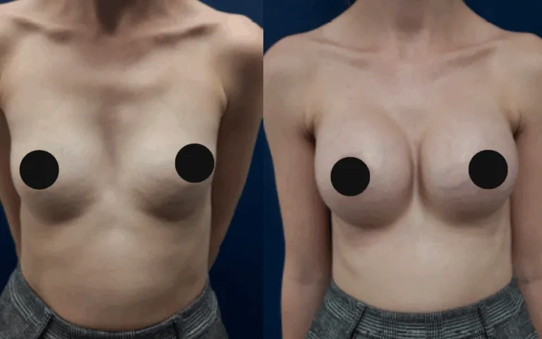 before and after breast implant lux plastic surgery in bedford